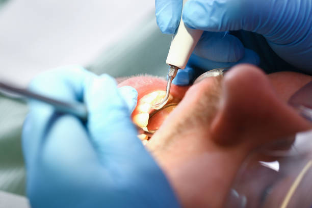 Best Emergency Tooth Extraction in Lealman, FL