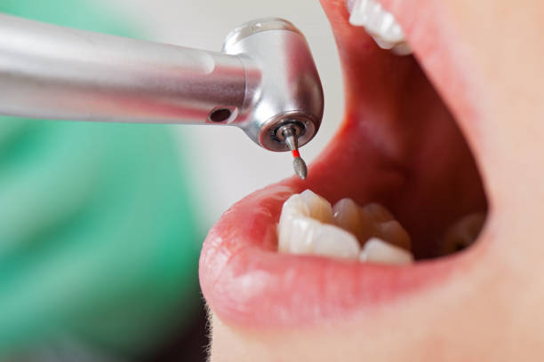 Best Emergency Wisdom Teeth Removal in Lealman, FL